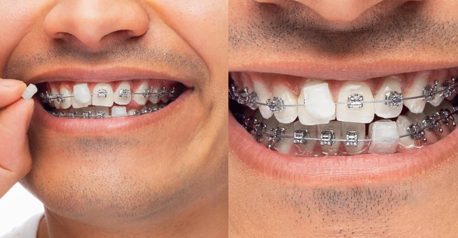 Can I eat with orthodontic wax in my mouth Inblog